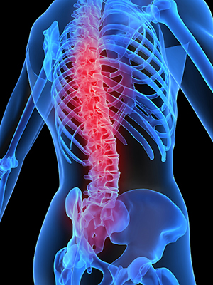 Acute Spinal Injury Acute Spinal Injury