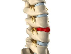 Bulging or Herniated Discs Bulging or Herniated Discs